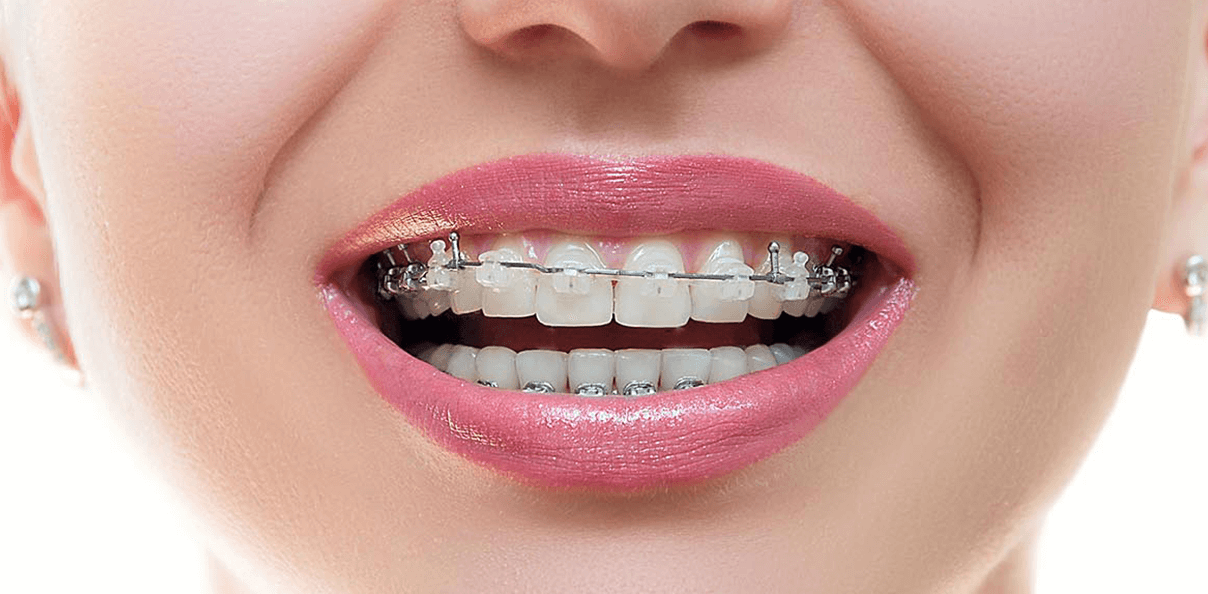 Alignment Conventional Braces